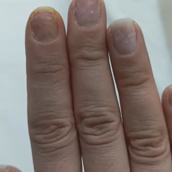 Valeria Beauty Hijyenik Olmayan Salon Ve Kalitesiz Protez Tırnak Nedeniyle Enfeksiyon