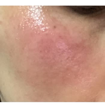 Bbl İşleminde Yanık Ve Melazma Merkezin Sorumluluğu Reddetmesi