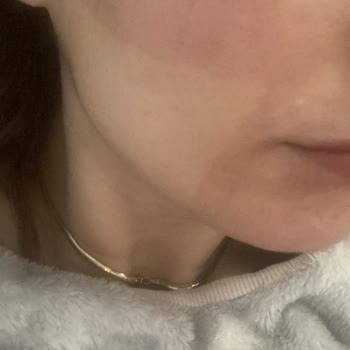 Bbl İşleminde Yanık Ve Melazma Merkezin Sorumluluğu Reddetmesi