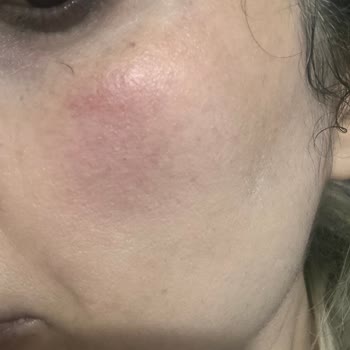 Bbl İşleminde Yanık Ve Melazma Merkezin Sorumluluğu Reddetmesi