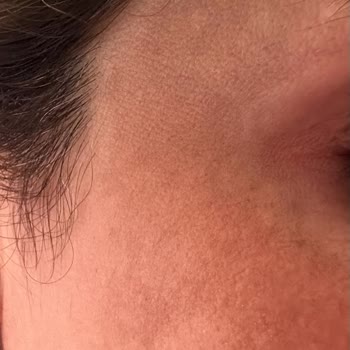 Bbl İşleminde Yanık Ve Melazma Merkezin Sorumluluğu Reddetmesi