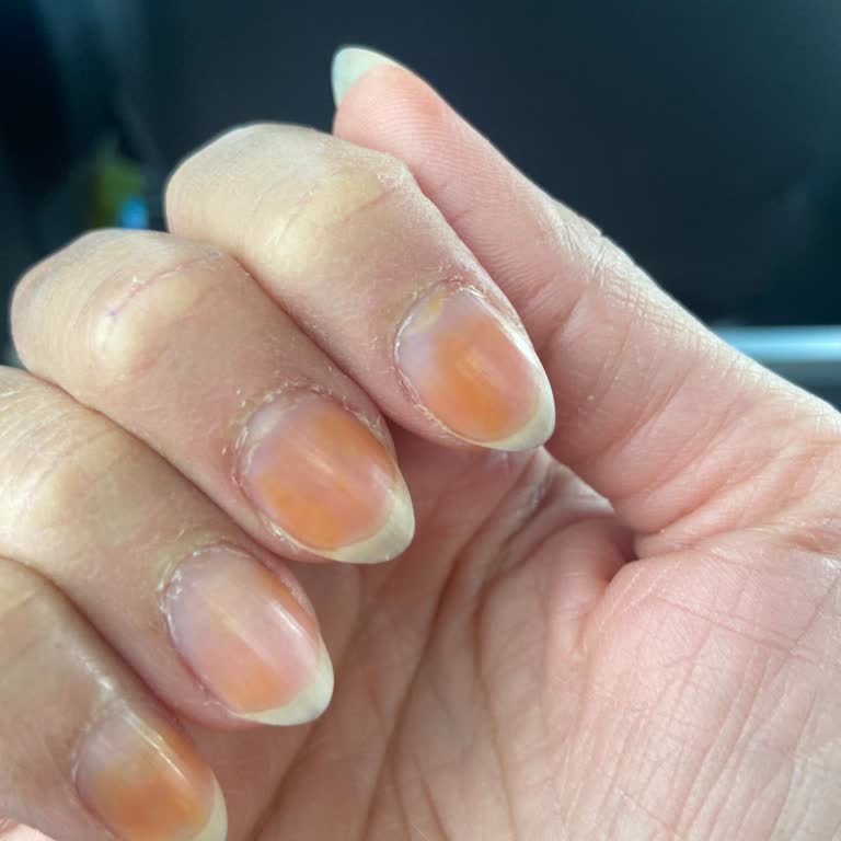 Kalyon Tırnak Koruyucusunun Ani Renk Değişimi Ve Sağlık Endişeleri