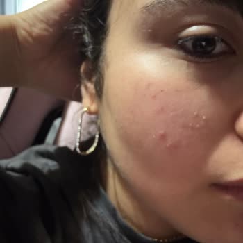 Note Markasının Liquid Blush'unda Cilt Sivilcelenmesi Ve Renk Değişikliği