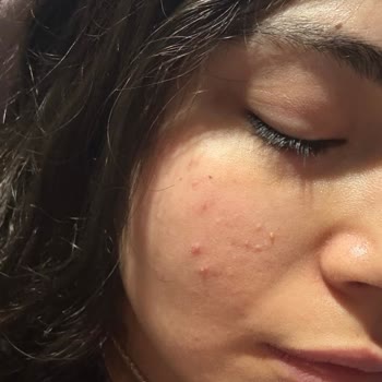 Note Markasının Liquid Blush'unda Cilt Sivilcelenmesi Ve Renk Değişikliği