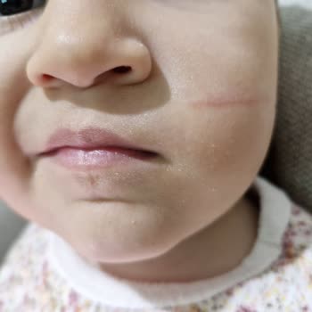 Bebek Suyu Şişesindeki Plastik Çapak Çocuğun Yüzüne Çizik Bıraktı