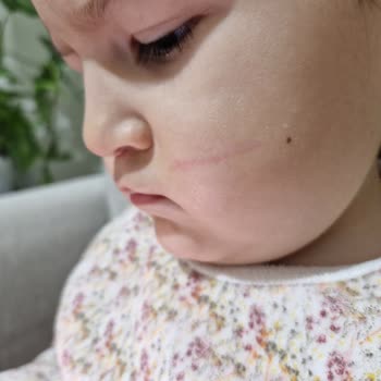 Bebek Suyu Şişesindeki Plastik Çapak Çocuğun Yüzüne Çizik Bıraktı