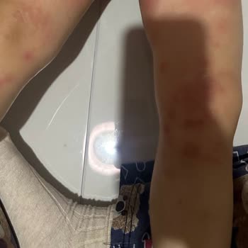 Eti Cici Bebe'de Şiddetli Alerjik Reaksiyon Ve Acil Tedavi