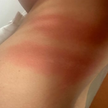 Peros Deterjanı Nedeniyle Alerjik Reaksiyon Ve Hastane Tedavisi