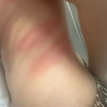 Peros Deterjanı Nedeniyle Alerjik Reaksiyon Ve Hastane Tedavisi