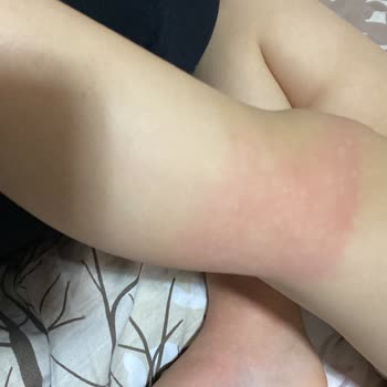 Peros Deterjanı Nedeniyle Alerjik Reaksiyon Ve Hastane Tedavisi