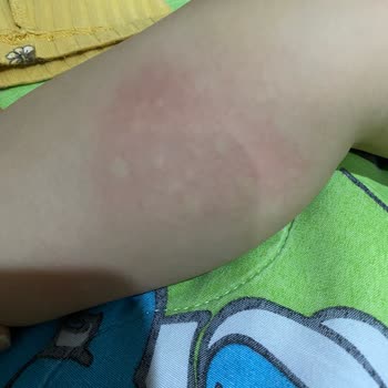 Peros Deterjanı Nedeniyle Alerjik Reaksiyon Ve Hastane Tedavisi