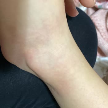 Peros Deterjanı Nedeniyle Alerjik Reaksiyon Ve Hastane Tedavisi