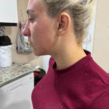 Isana Rossmann İzmir Optimum'da Aktif Kömür Maskesi Cilt Yanması Ve İade Talebi