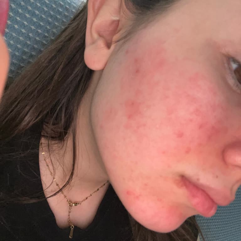 Sinoz Yüz Yıkama Jelinde Alerjik Reaksiyon Ve Masraf İadesi Talebi