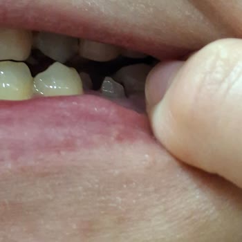 BİM Vişne Reçelindeki Çekirdek Dişimi Kırdı, Tedavi Masraflarımın Karşılanmasını İstiyorum