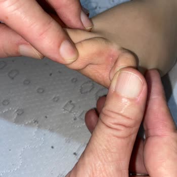 Vicco Ayakkabısında Küf Oluşumu Ve Mantar Enfeksiyonu