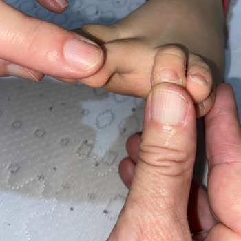 Vicco Ayakkabısında Küf Oluşumu Ve Mantar Enfeksiyonu