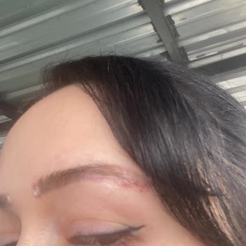 Kalıcı Kaş İşleminde Yara Ve Kanama, 2800 TL İadesi Talebi