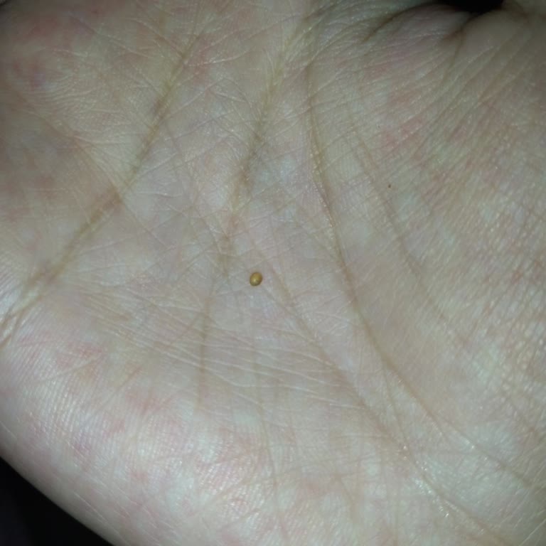 Hisar Kahve Türk Kahvesinde Şeffaf Sert Parçalar Ve Sağlık Endişesi