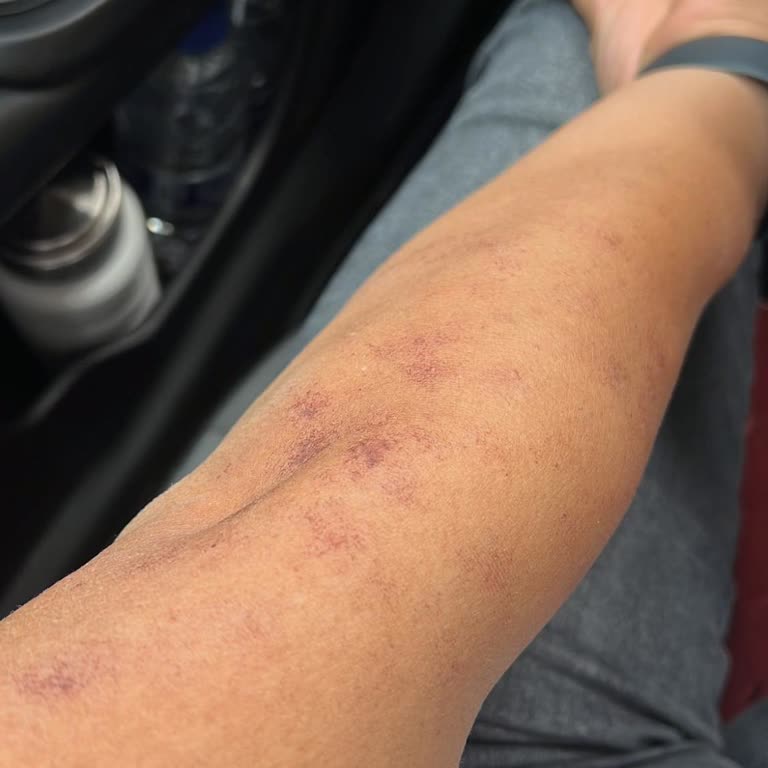 Yanık Ve İzli Lazer Epilasyon, Eksik Tedaviler İçin Acil Çözüm Talebi