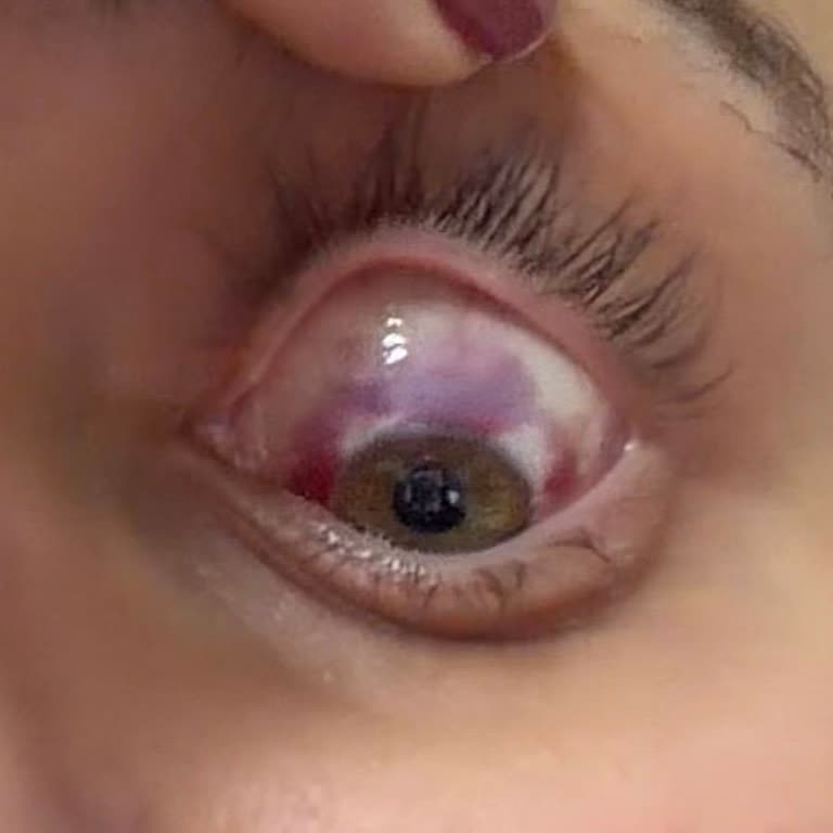 Lazer Ameliyatı Sırasında Cihaz Arızası Ve Gözde Kanama Şikayeti