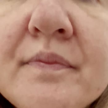 Garnier C Vitamini Serumu Kullanımında Şiddetli Kızarıklık Ve Kabarcıklar İade Talebi