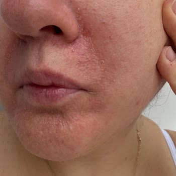 Garnier C Vitamini Serumu Kullanımında Şiddetli Kızarıklık Ve Kabarcıklar İade Talebi