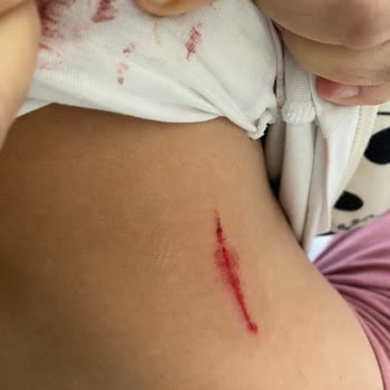 Paslı Demir Çocuk Oyun Alanında Yaralanmaya Yol Açtı