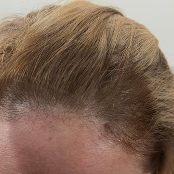 Elit Kuaför (Eryaman) Saç Boyama İşleminde Kesilme, Yanma