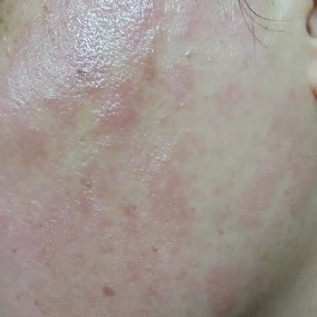 Yüz Lazer Epilasyonda Dikkatsiz Uygulama Sonucu Yanıklar Ve Telafi Talebi