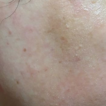 Yüz Lazer Epilasyonda Dikkatsiz Uygulama Sonucu Yanıklar Ve Telafi Talebi