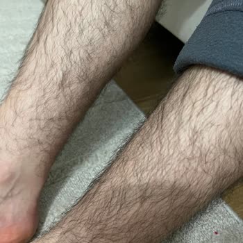 Yedi Seans Lazer Epilasyon Sonucu Hiç Azalma Olmadı Ve Cihaz Orijinalliği Şüpheli