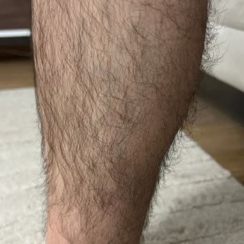 Yedi Seans Lazer Epilasyon Sonucu Hiç Azalma Olmadı Ve Cihaz Orijinalliği Şüpheli