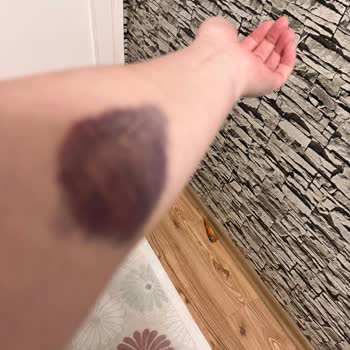 Yüzyıl Gebze Hastanesi Acil Serviste Serum Takma İşlemlerinde Şiddetli Morarma Ve Damar Patlaması