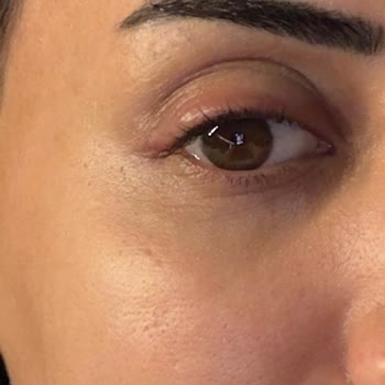 Flormar Göz Kalemi Şiddetli Alerjik Reaksiyon Ve Göz Kapağı Şişliği