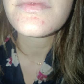 Rise And Shine Yüz Peeling Jelinde Şiddetli Sivilce Ve İade Talebi