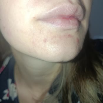 Rise And Shine Yüz Peeling Jelinde Şiddetli Sivilce Ve İade Talebi