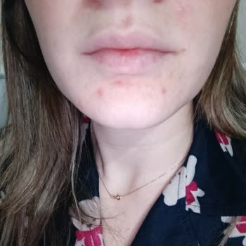 Rise And Shine Yüz Peeling Jelinde Şiddetli Sivilce Ve İade Talebi