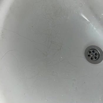 Kaynak Saç İşleminden Saç Dökülmesi Ve Cevapsız İlgisizlik Nedeniyle Ücret İadesi Talebi