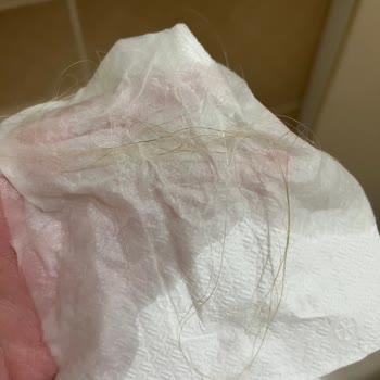 Kaynak Saç İşleminden Saç Dökülmesi Ve Cevapsız İlgisizlik Nedeniyle Ücret İadesi Talebi