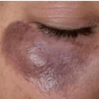 Dr. Hakan Buzoğlu Yanlış Lazer Uygulaması Sonrası Göz Altı Yanığı Ve Kalıcı Hasar