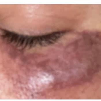 Dr. Hakan Buzoğlu Yanlış Lazer Uygulaması Sonrası Göz Altı Yanığı Ve Kalıcı Hasar