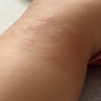 Mustela Bebek Şampuanı Ve Yağı Egzama Yaratıyor, Ücret İadesi İstiyorum