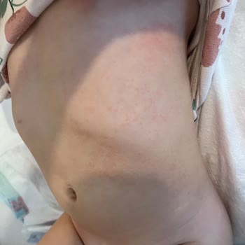 Mustela Bebek Şampuanı Ve Yağı Egzama Yaratıyor, Ücret İadesi İstiyorum