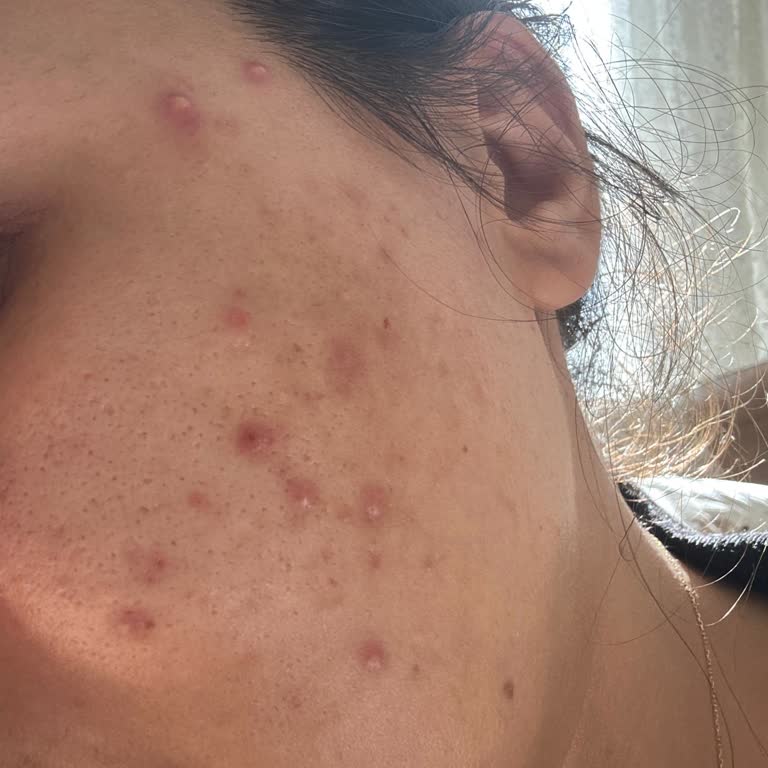 La Roche-Posay Mikrobiyom Jel Kullanımından Sonra Şiddetli Akne Ve İltihaplı Cilt Reaksiyonu