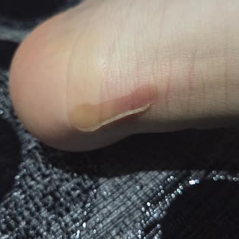 Ayak Yarası Yapan İnci Ayakkabısı İçin İade Talebi