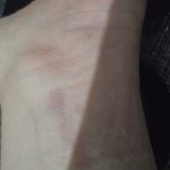 Ayak Yarası Yapan İnci Ayakkabısı İçin İade Talebi