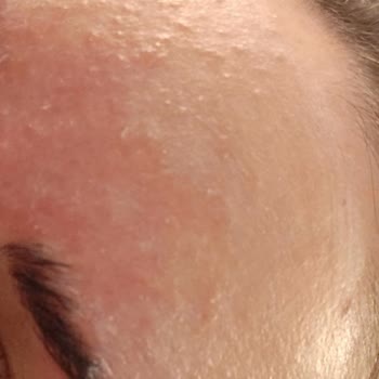 Skin Sensual BB Kremi Cilt Bariyerimi Bozdu, Şiddetli Egzama Oluşturdu Ve Yorumlarım Reddedildi