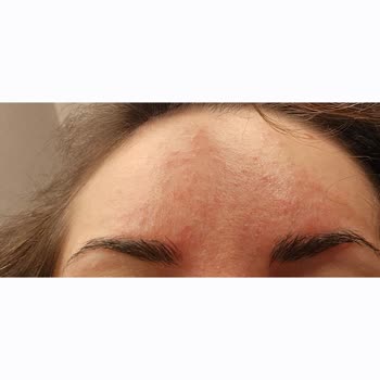 Skin Sensual BB Kremi Cilt Bariyerimi Bozdu, Şiddetli Egzama Oluşturdu Ve Yorumlarım Reddedildi