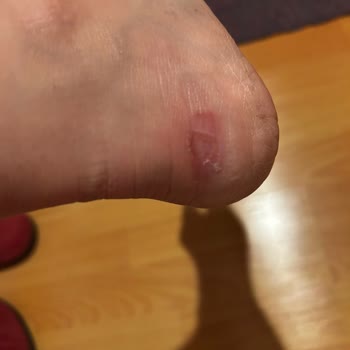 Nine West Botunun İç Yapısındaki Kusur Nedeniyle Ayağımda Ciddi Yaralanma Ve İade Talebi